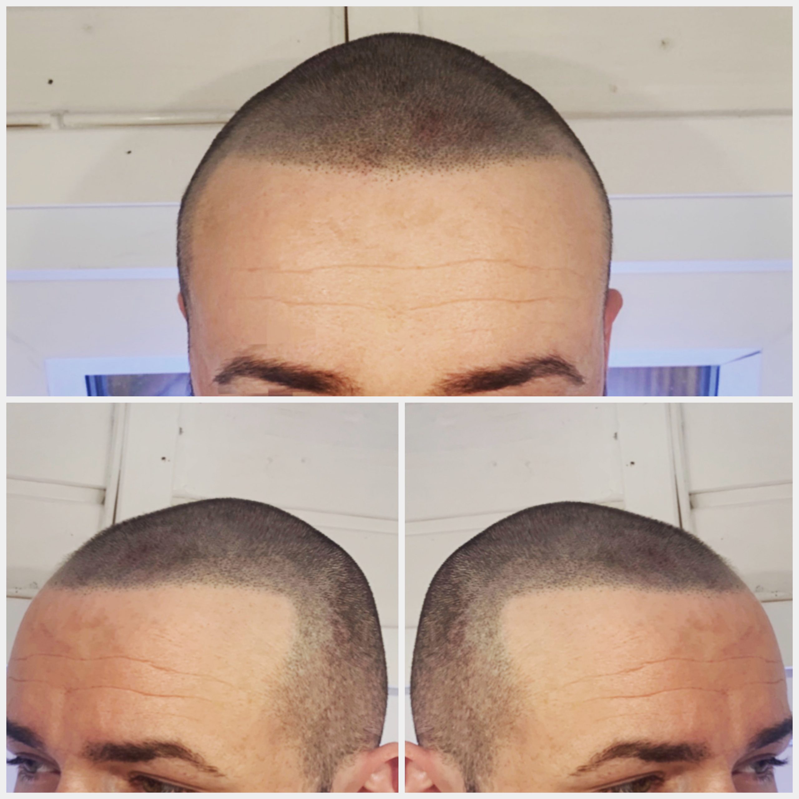 san antonio scalp micropigmentation