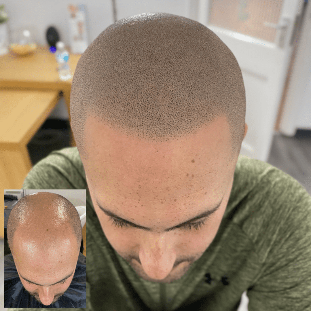 Benefits Of Taking Scalp Micropigmentation